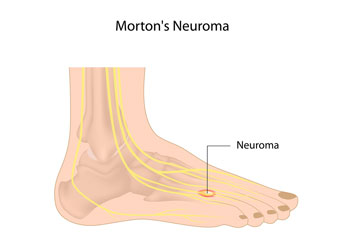 neuromas